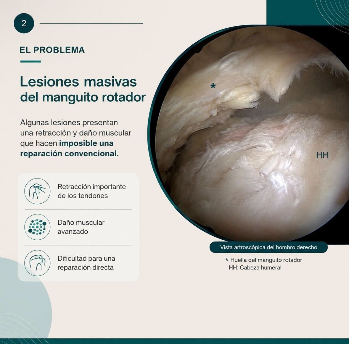 Lesiones masivas irreparables del manguito rotador