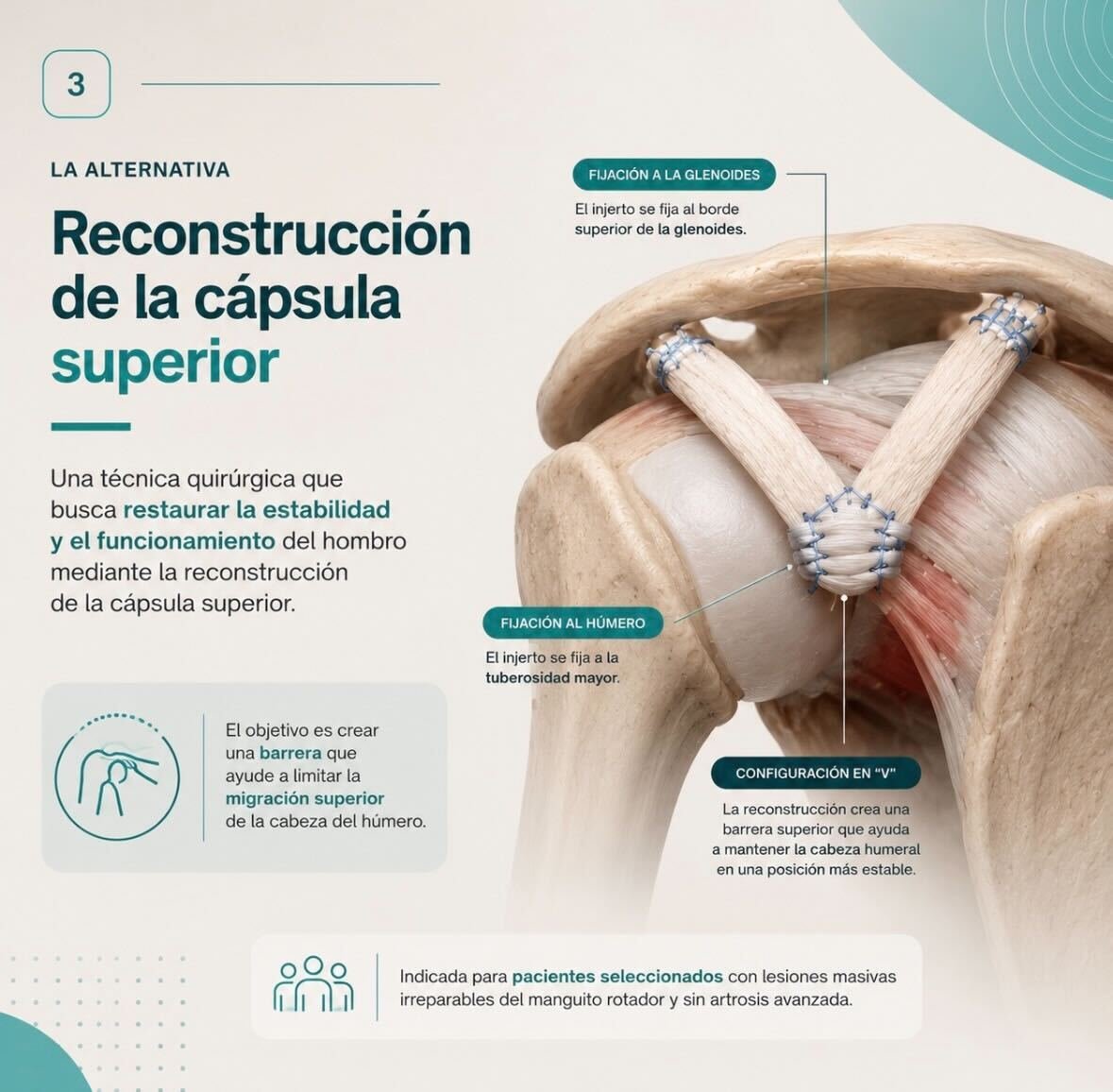 Diagrama de reconstrucción artroscópica de cápsula superior con injerto en V
